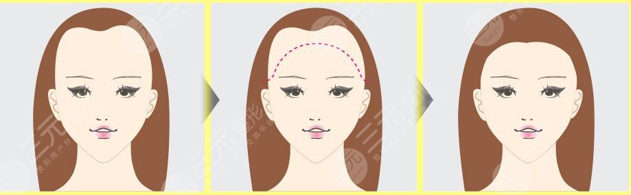 紋發(fā)際線和植發(fā)哪個(gè)好？區(qū)別對(duì)比分析！術(shù)前必看~