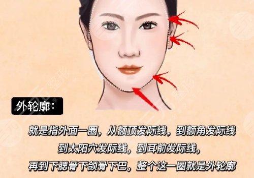 輪廓整形1個(gè)月和6個(gè)月對(duì)比圖