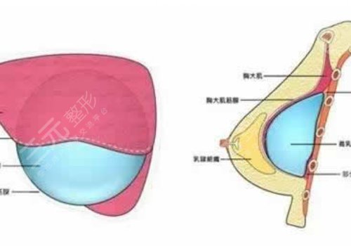 毛面假體和光面假體哪個好?