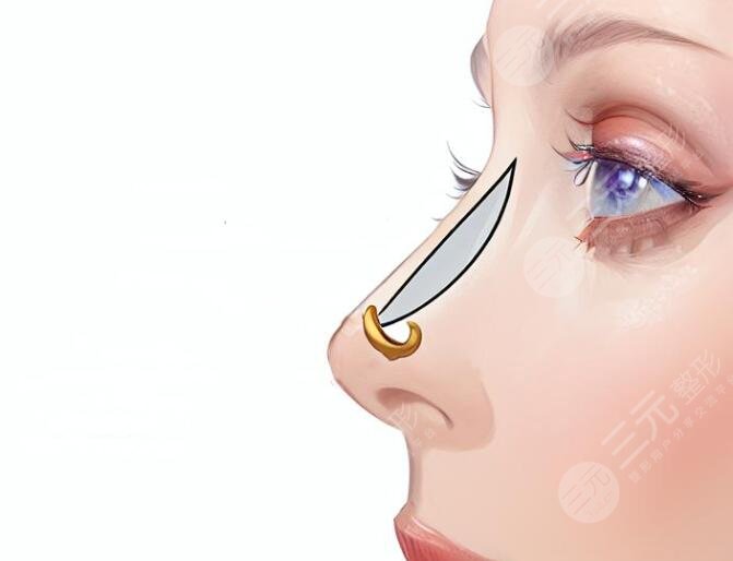 做了直鼻微翹之后可以用維持多長時間?