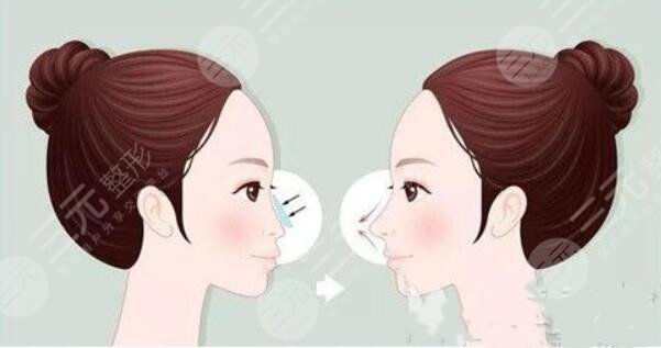 做完媽生鼻或者是直鼻微翹手術之后需要注意什么?