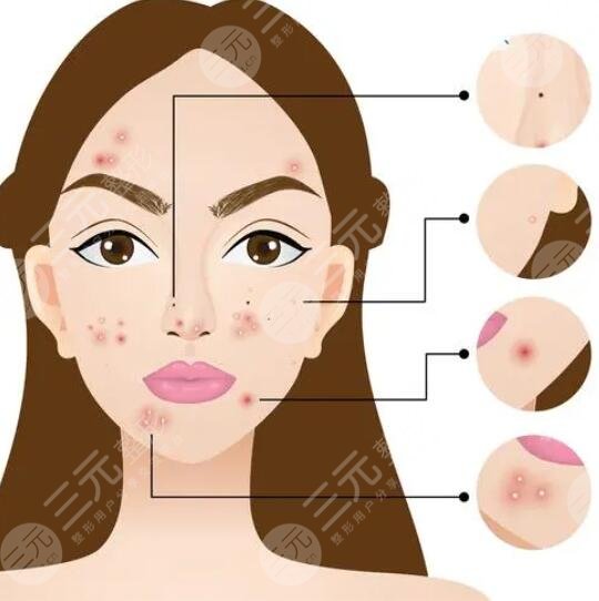 去痘印要多少錢一次?