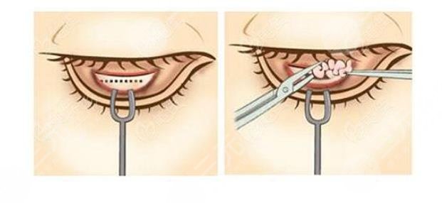 外切眼袋一般要多久才能完全恢復(fù)
