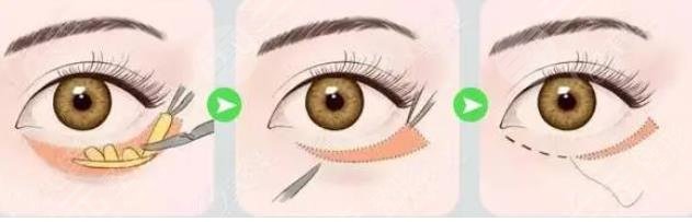 外切眼袋一般要多久才能完全恢復(fù)