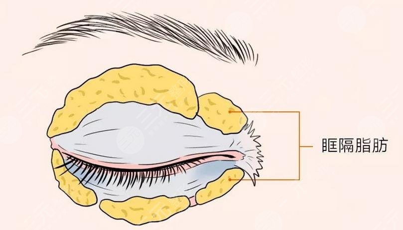 內(nèi)切眼袋多久恢復(fù)正常