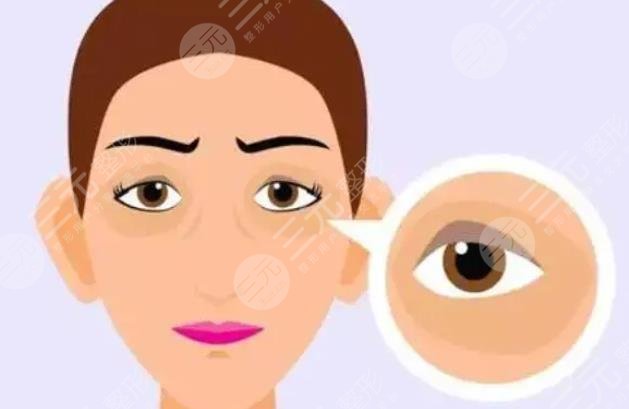 內(nèi)切眼袋多久恢復(fù)正常