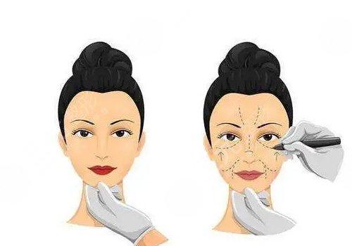 微調(diào)整形有風險嗎？