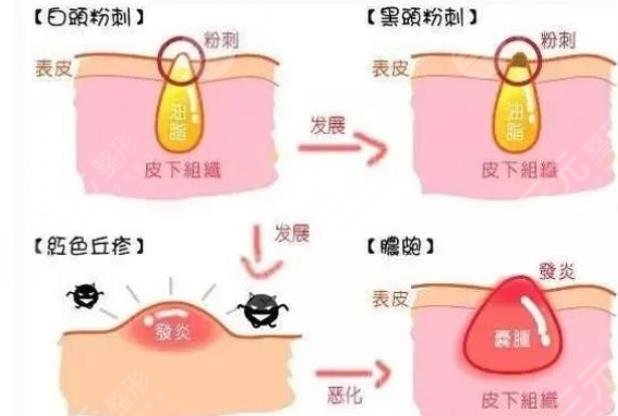 閉合性粉刺怎么清理