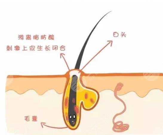 閉合性粉刺怎么調(diào)理