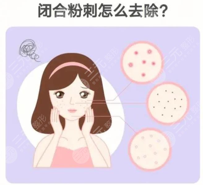 閉合性粉刺怎么調(diào)理