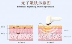 激光嫩膚有副作用嗎？醫(yī)美入門常識(shí)分享！優(yōu)缺點(diǎn)講解，值得做~