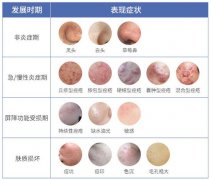 治痤瘡花多少錢？?jī)r(jià)格參考！祛痘別盲目，痘肌的避雷功課來(lái)了~