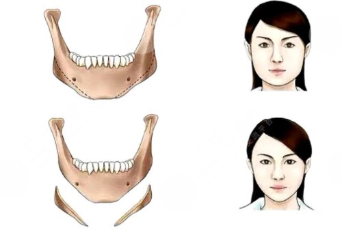 國字臉削骨手術(shù)風險大嗎？