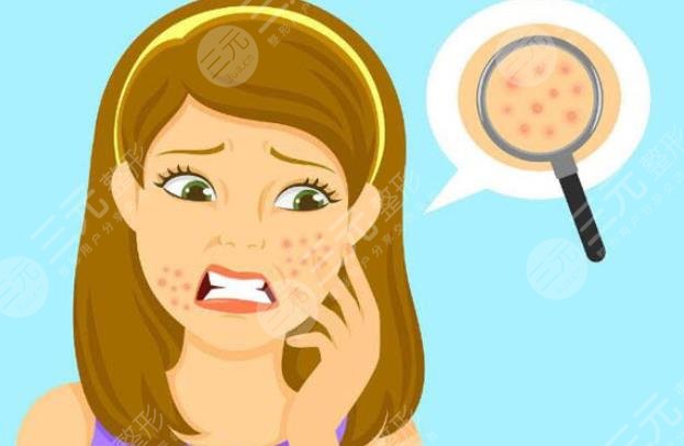 閉合性粉刺多久能好