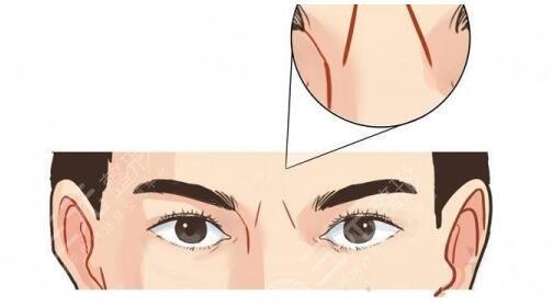 射頻除皺價(jià)格是多少?