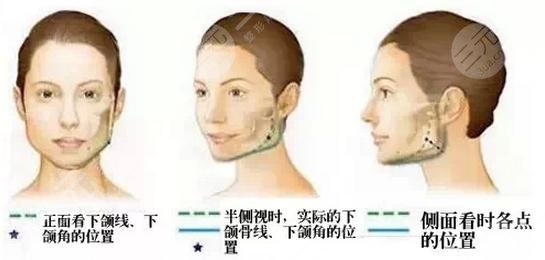 國字臉削骨手術(shù)風險大嗎？