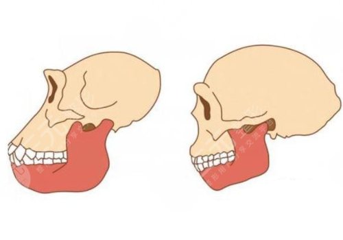 削骨三年后的真實案例圖片