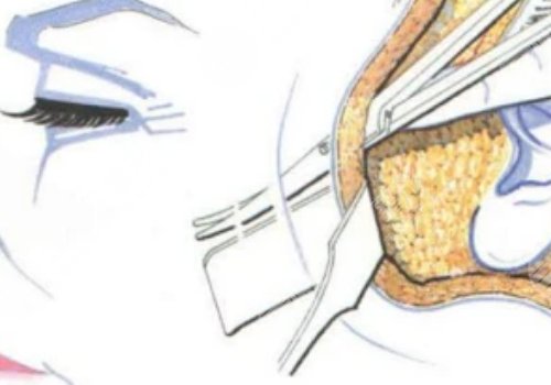 大拉皮手術(shù)15天是什么樣子？