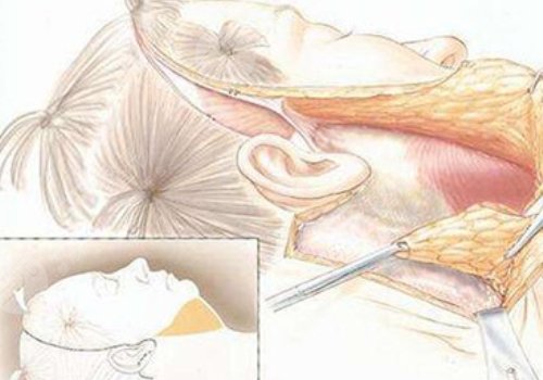 大拉皮手術(shù)15天是什么樣子？
