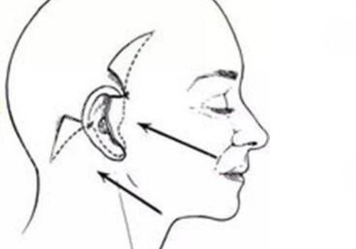 大拉皮手術(shù)15天是什么樣子？