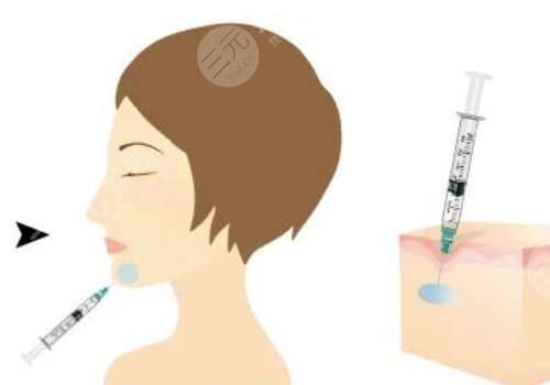 正規(guī)醫(yī)院注射除皺價格是多少？