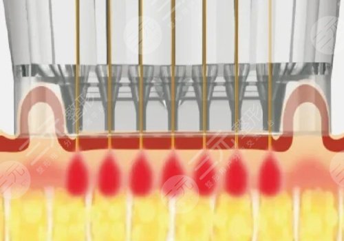 微針美塑和黃金微針的區(qū)別盤點
