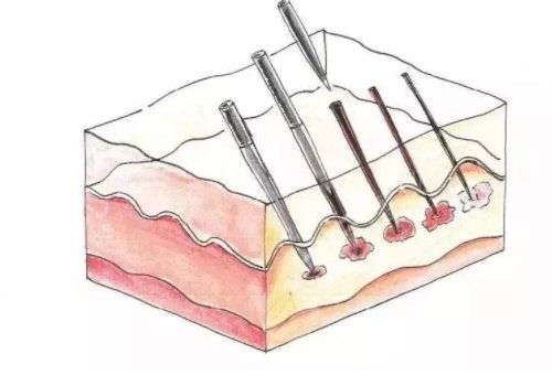 微針美塑和黃金微針的區(qū)別盤點