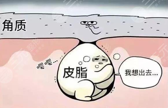 閉合性粉刺怎么徹底去除