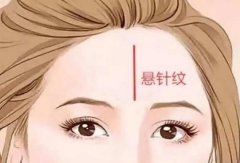 怎么去掉懸針紋，可以手術(shù)嗎？除皺緊膚，一文講解！