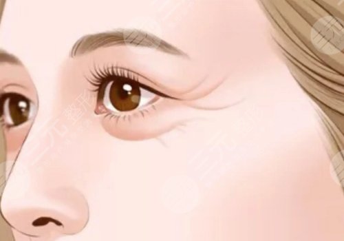 電波拉皮多久做一次合適？