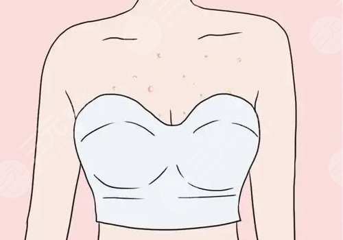 水滴形假體容易移位嗎?