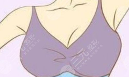 水滴形假體有光面的嗎？