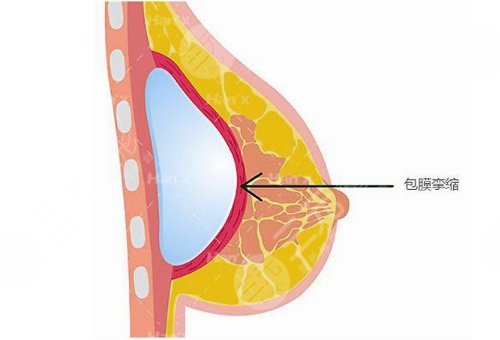 水滴形假體有光面的嗎？