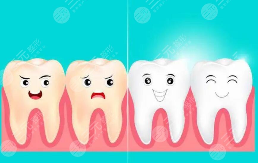 冷光美白牙齒的注意事項