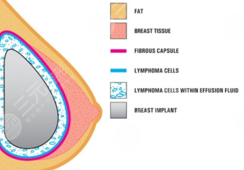 水滴形假體隆胸多少錢？