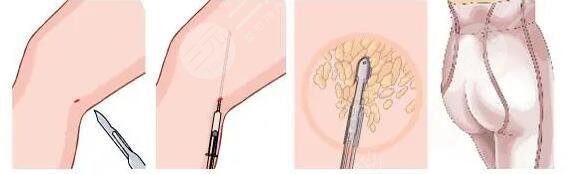武漢亞太程曉林案例吸脂體驗(yàn)