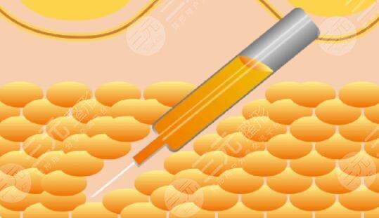 武漢亞太程曉林案例吸脂體驗(yàn)