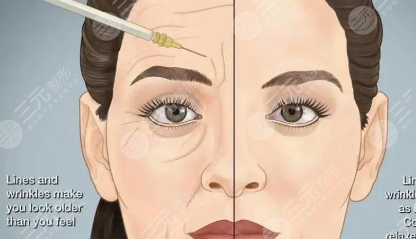 注射除皺安全嗎可靠嗎？有效果嗎？基本原理