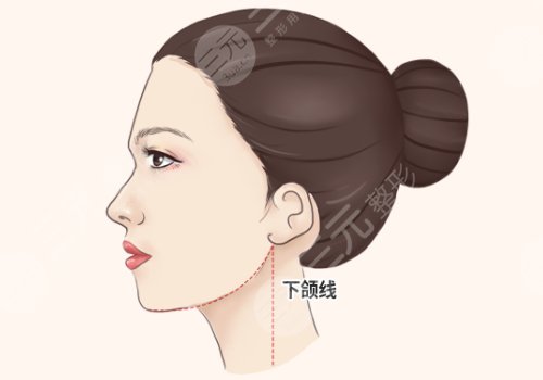 面部輪廓整形包括哪些種類(lèi)(項(xiàng)目)？