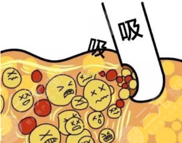 全身抽脂50斤的價(jià)格要5w？