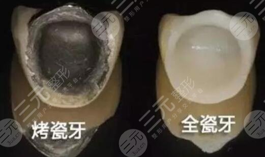 烤瓷美白牙齒多少錢?