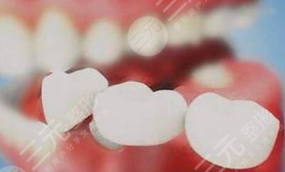 烤瓷牙該換了的征兆