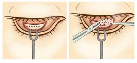 內切眼袋手術警惕三大后遺癥