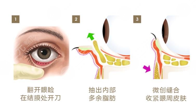 內切眼袋手術警惕三大后遺癥