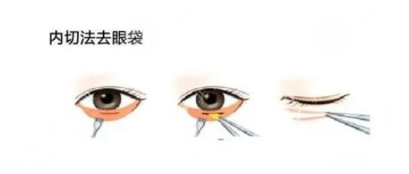 內切眼袋手術警惕三大后遺癥