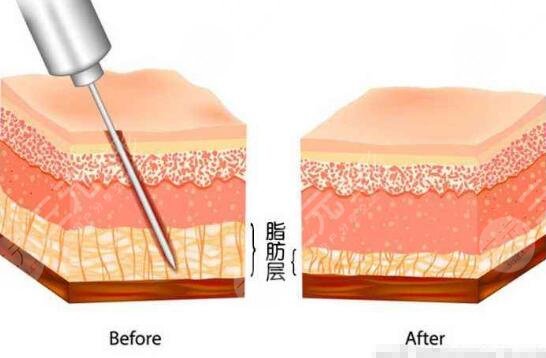 男士乳房肥大吸脂手術(shù)費用多少？價格標準公開！術(shù)前科普~