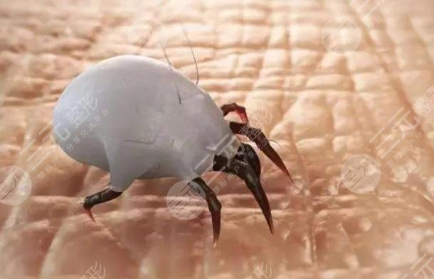 螨蟲(chóng)感染皮膚的癥狀