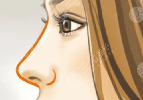 美國菲斯挺膨體適合放在鼻子哪里？