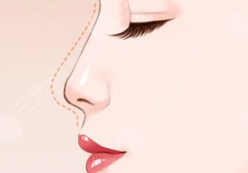 美國菲斯挺膨體適合放在鼻子哪里？