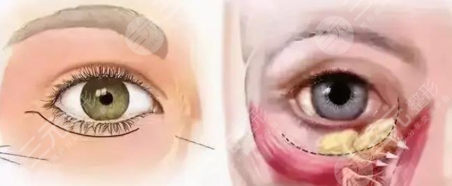 外切眼袋恢復(fù)過程圖